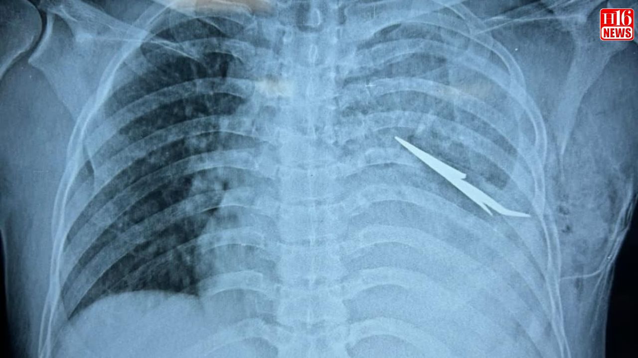 Doctors Remove Arrow Lodged Close To Man's Heart In Odisha